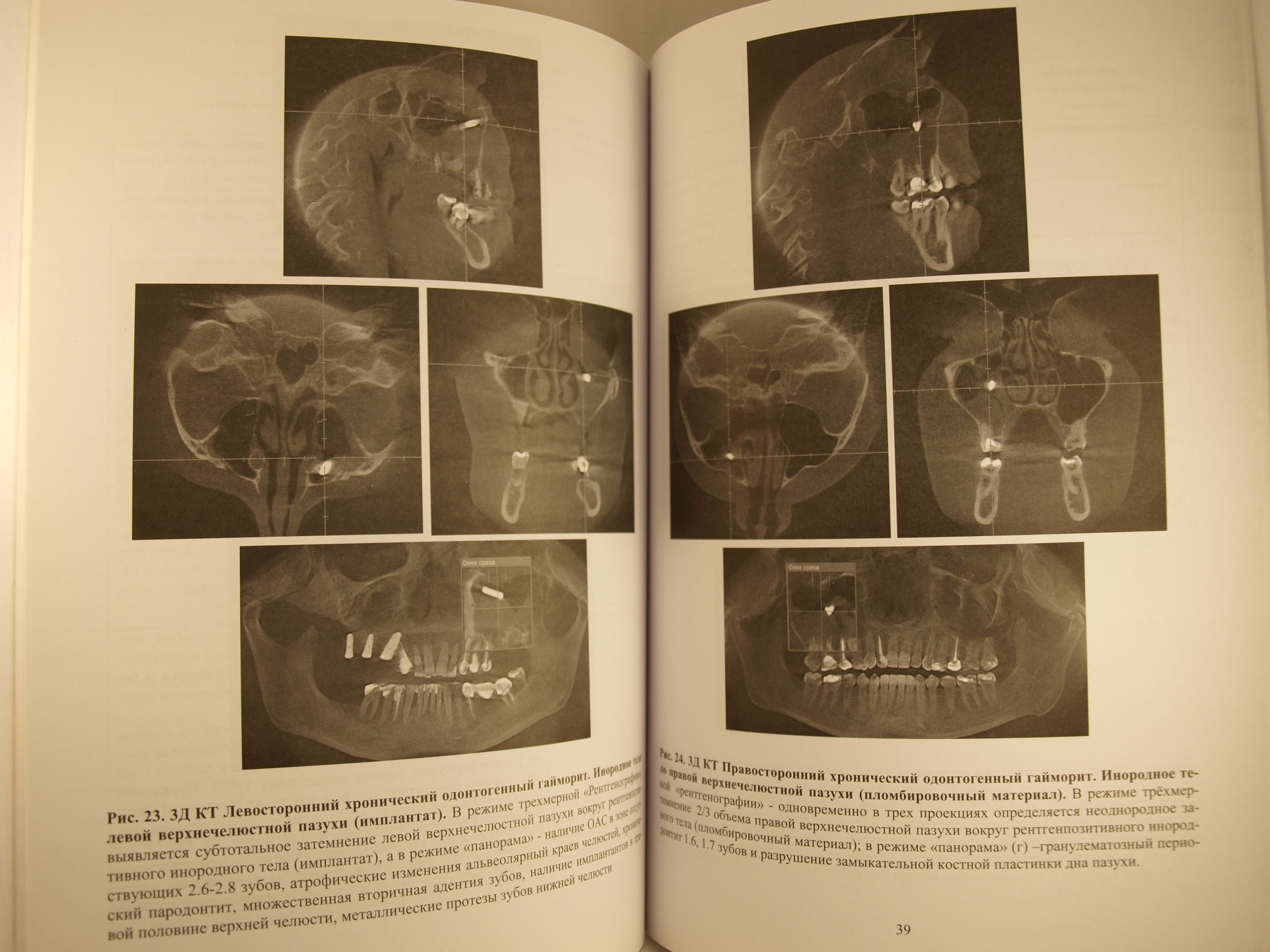 Цифровая объемная томография в оториноларингологии
